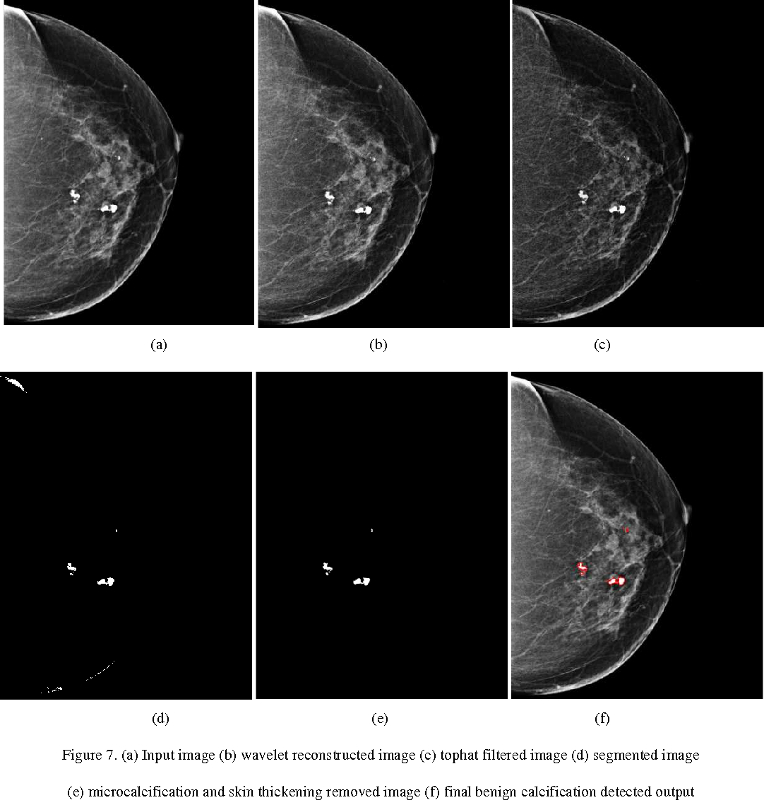 Albums 92+ Pictures Images Of Breast Cancer Mammograms Stunning