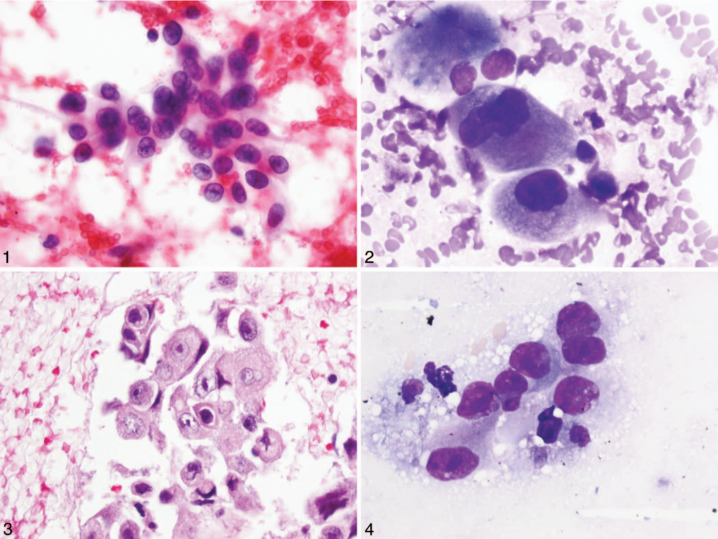 Morphologic Accuracy in Differentiating Primary Lung Adenocarcinoma ...