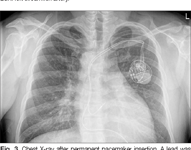 Transposition Of The Great Arteries X Ray