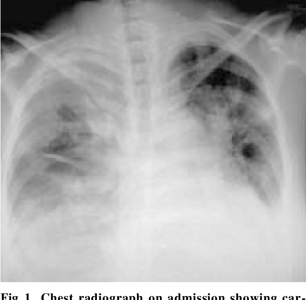 Figure 1 from Successfully treated triple valve infective endocarditis ...