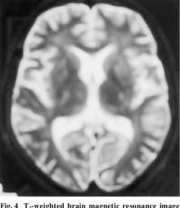 Figure 1 from Successfully treated triple valve infective endocarditis ...