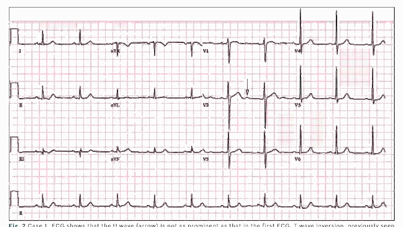 Figure 4 from Abnormal ECGs secondary to electrolyte abnormalities ...