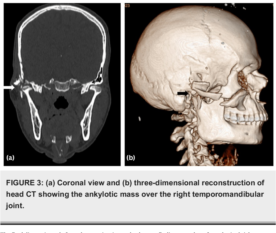 Figure 1 from Management of Ectropion Associated With a Malunited ...