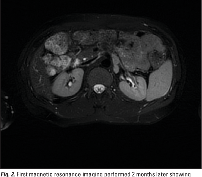 Figure 2 from Images - Para-aortic lymphatic ectasia suggestive of ...