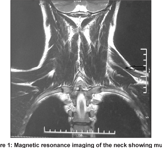 Figure 1 from Idiopathic spinal accessory nerve palsy: A case report ...