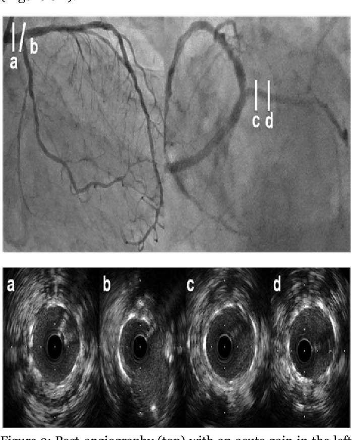 Figure 2 from Long inflation to left main coronary artery with kissing ...