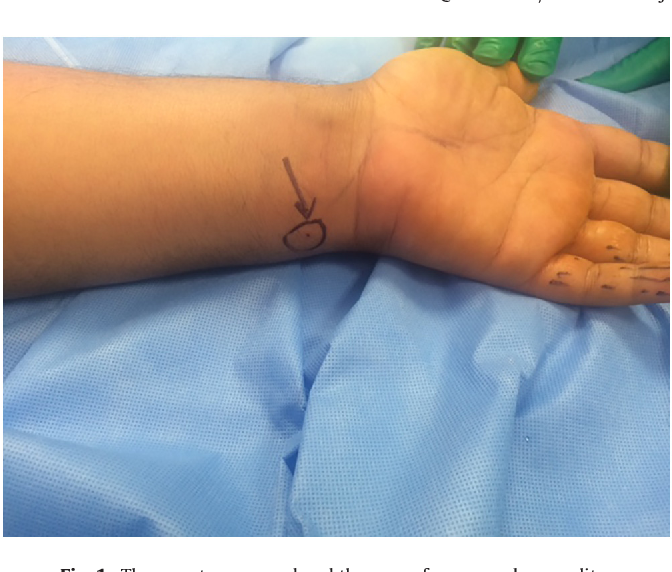 Figure 1 from High trifurcation of the ulnar nerve with the volar ...