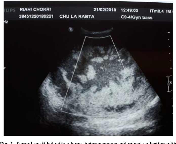 Epithelioid Histology Pleural Mesothelioma