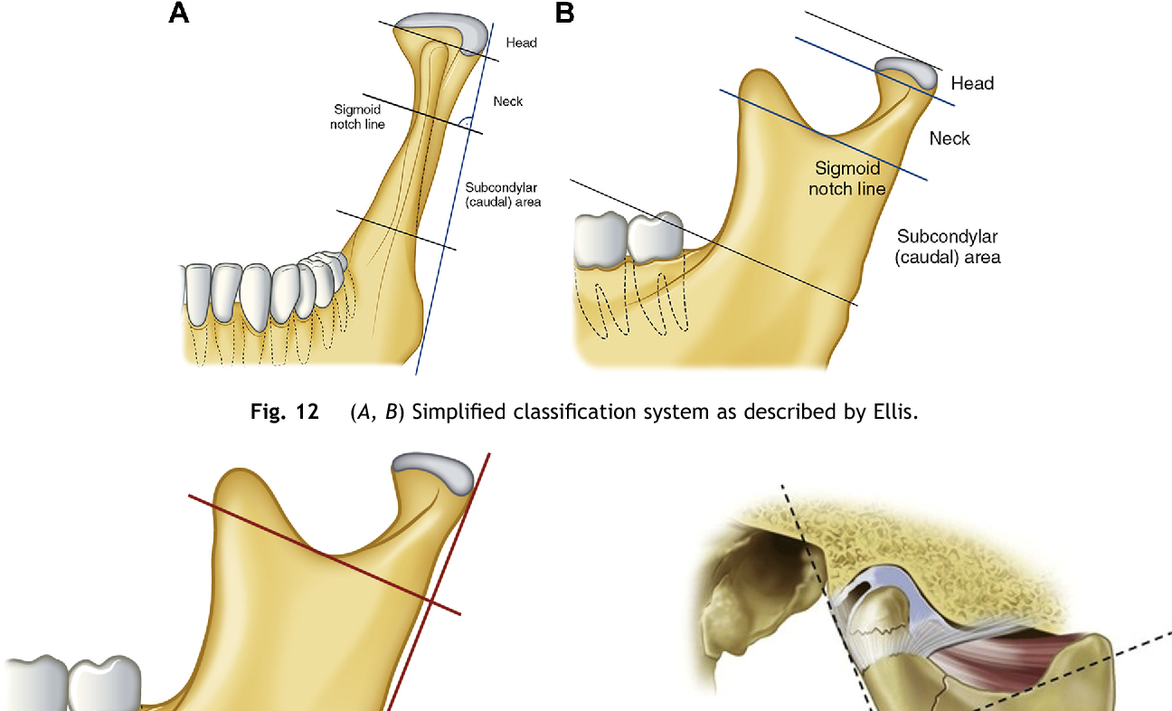 Mandibular Fracture Classification image.