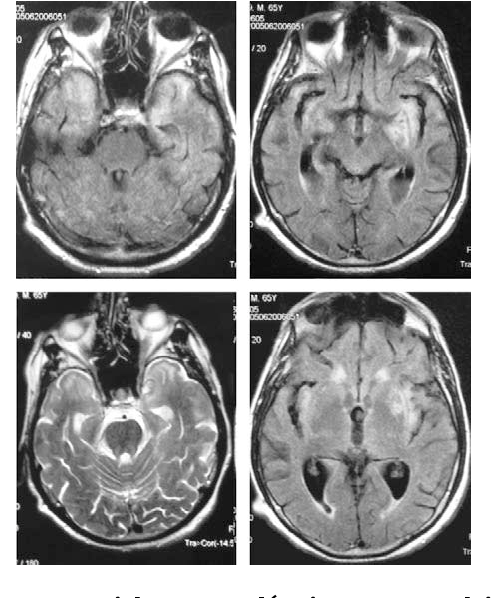 Neurosyphilis Mri