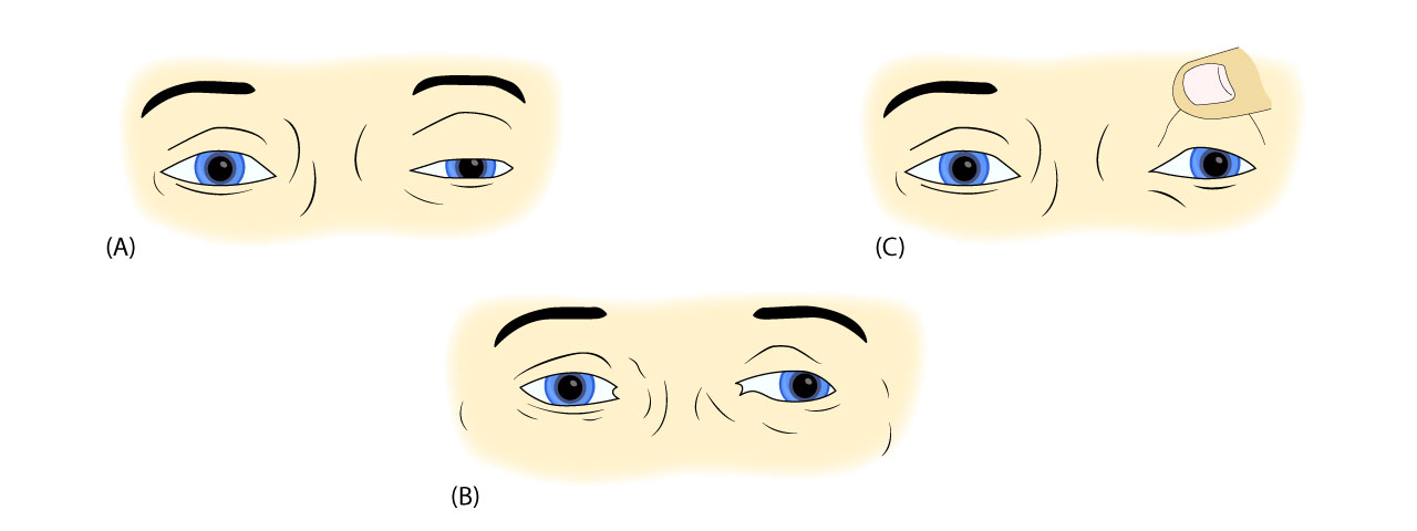 third cranial nerve