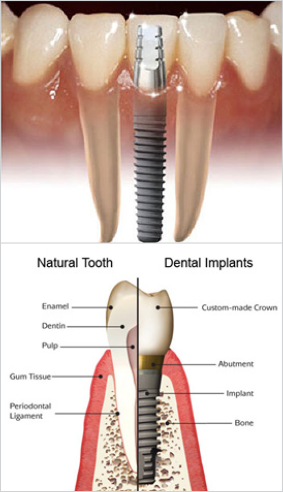 Dental Implants – Dairy Lane Dental