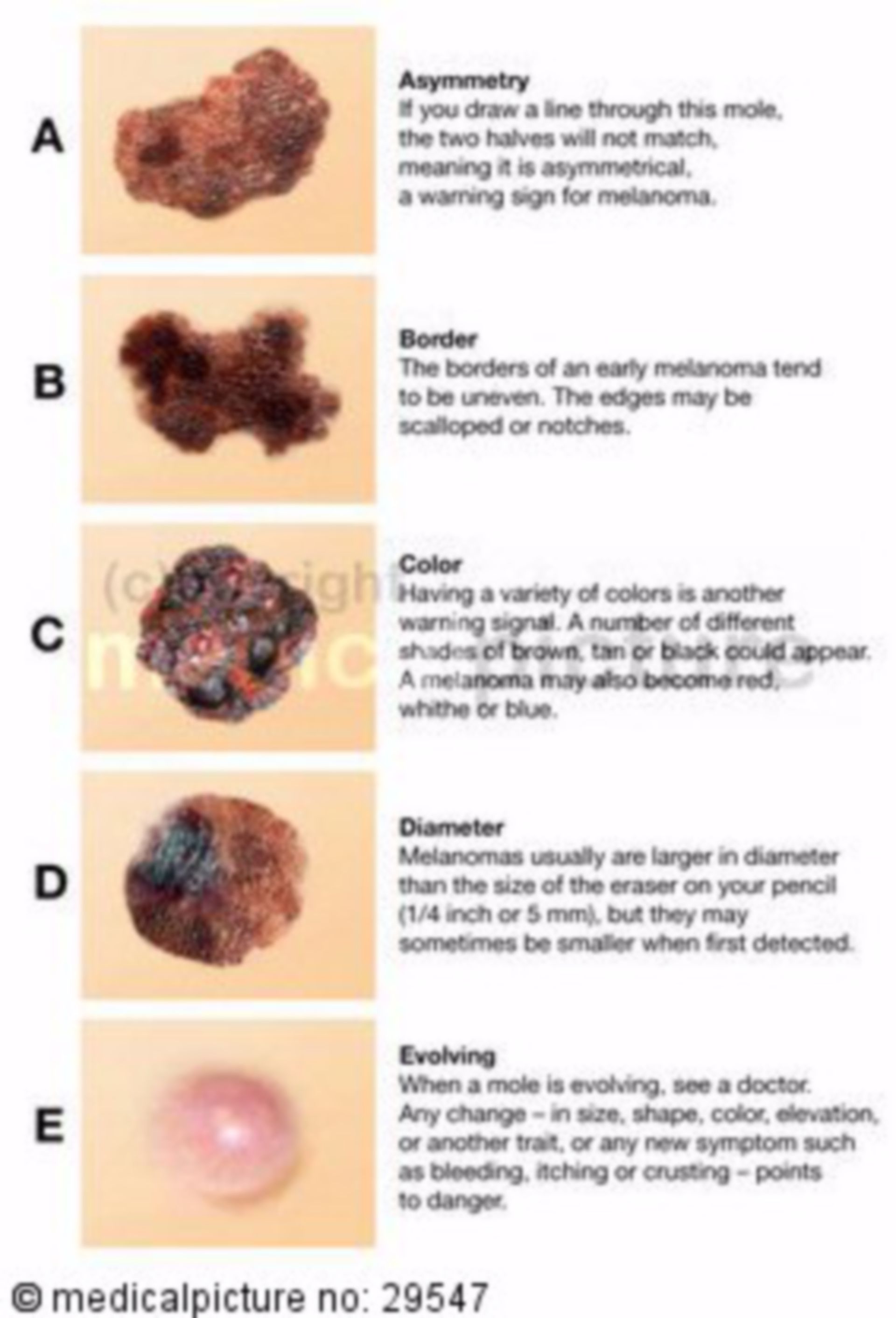 ABCDE Rule For Skin Cancer: What It Means And How To Use It, 51% OFF