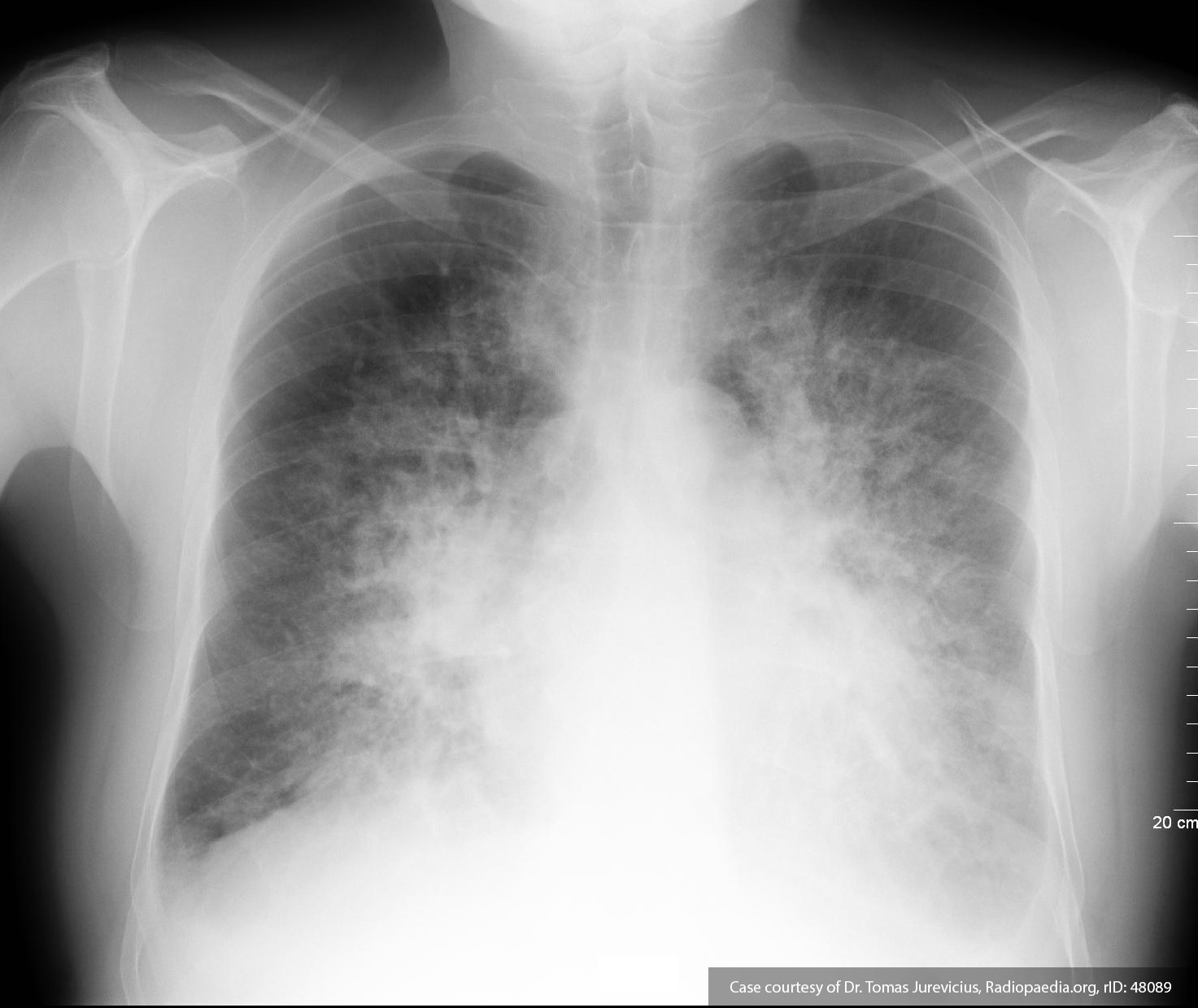 Pulmonary Edema Chest X Ray