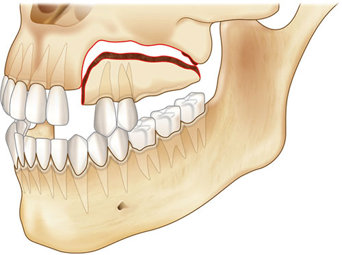 Maxillary Alveolar Process