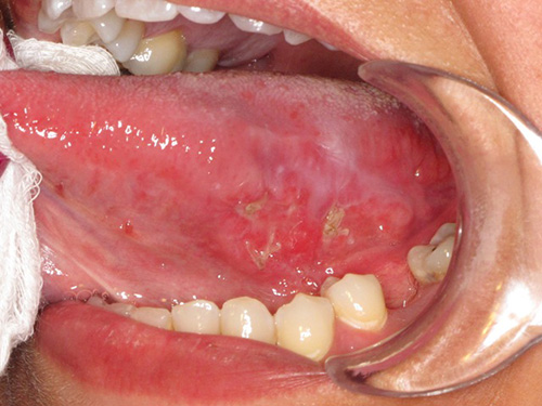 pictures of herpes in the mouth #11