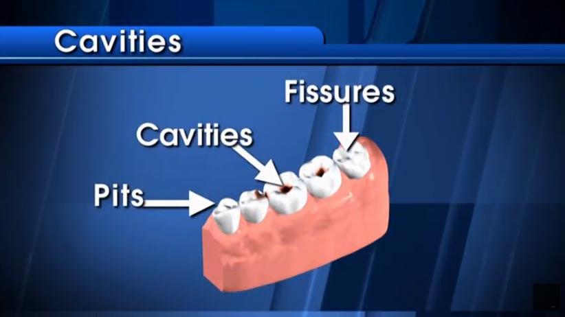 graphic depicting cavities in tooth click to see video