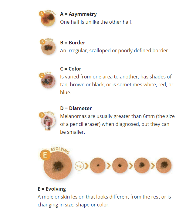 Malignant Melanoma Abcde