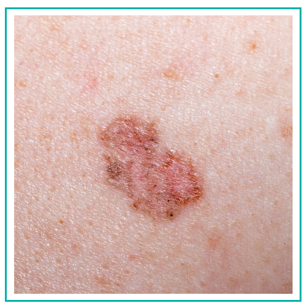 Cancer Types Types Of Basal Cell Carcinoma Skin Cance - vrogue.co