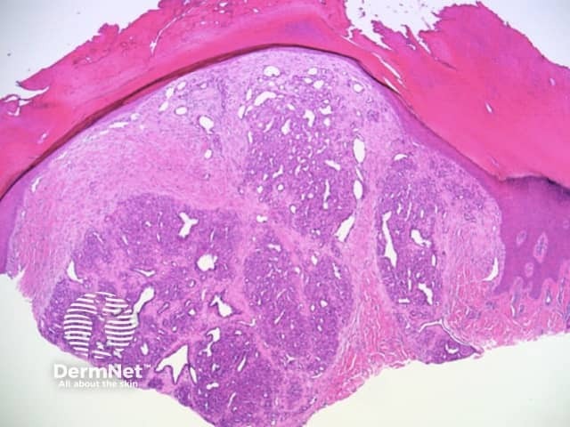 Dermal lobular arrangement of capillaries