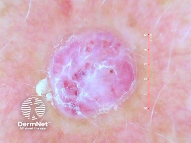 Pyogenic granuloma dermoscopy