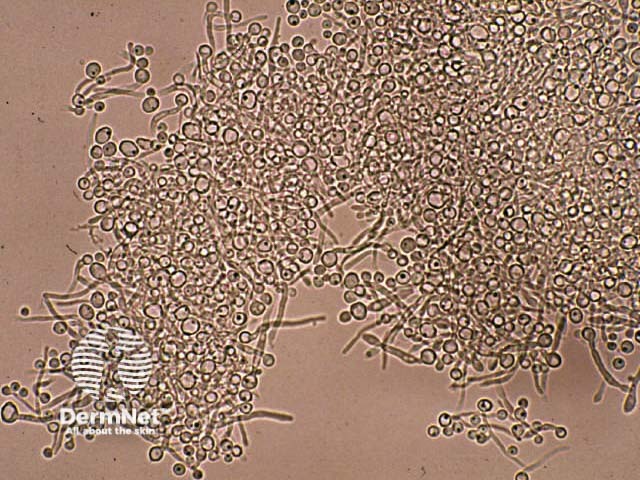 Lab tests for fungal infections