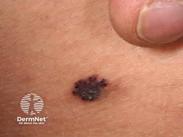 Pigmented angiokeratoma