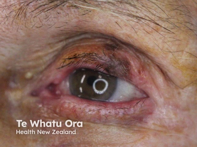 Eyelid melanoma