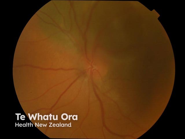 Uveal/choroidal melanoma