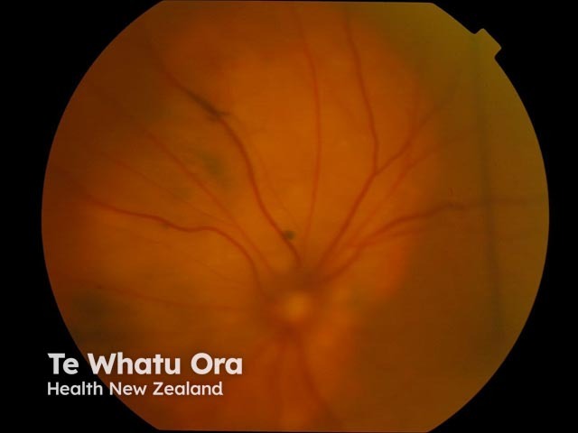 Uveal/choroidal melanoma