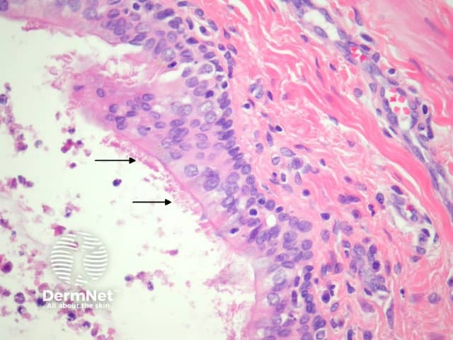 Bronchogenic cyst pathology