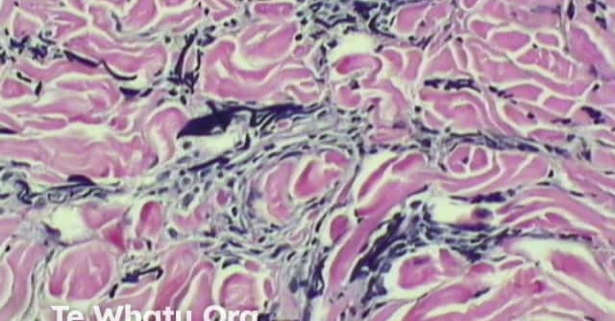 Pathology of cutis laxa image