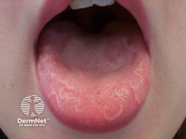 Geographic tongue