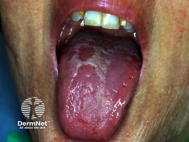 Geographic tongue