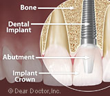 Dental Implants and Natural Teeth: the Similarities and the Differences ...