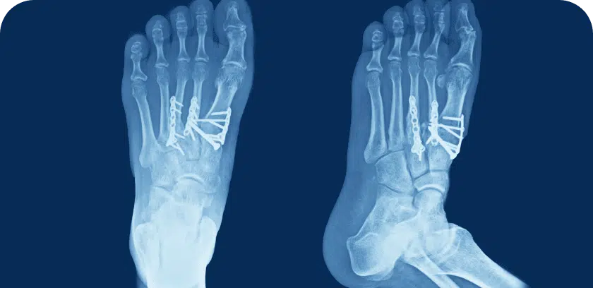 Lisfranc Injury treatment options