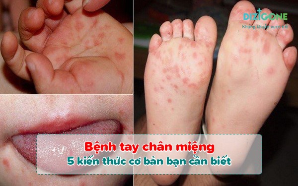 bệnh tay chân miệngbenh-tay-chan-mieng