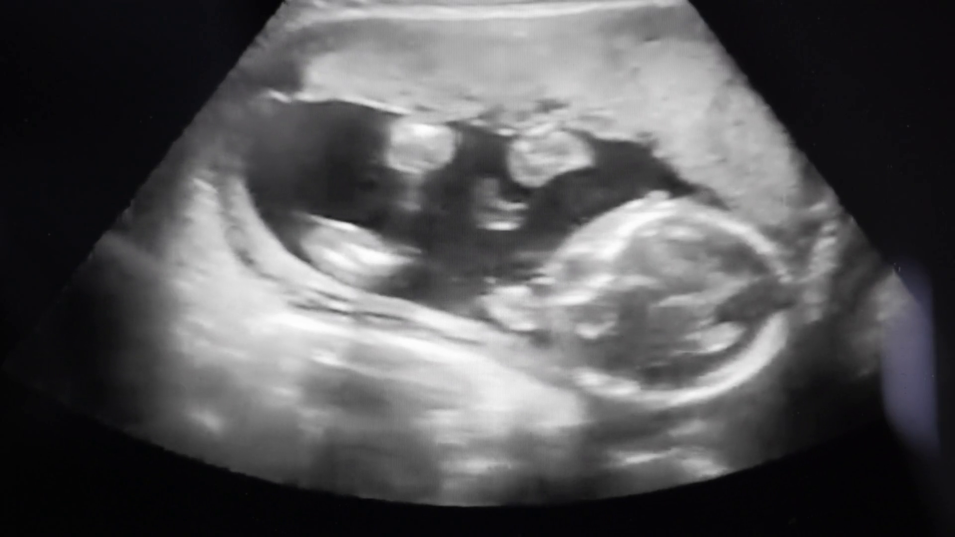 A Baby's Ultrasound In Mother's Womb Stock Footage SBV-312062426 ...