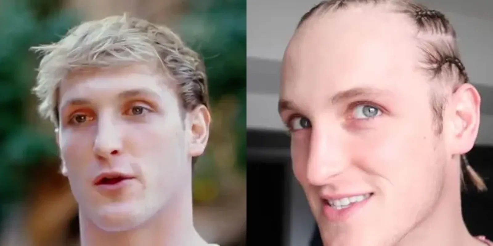 logan paul hairline