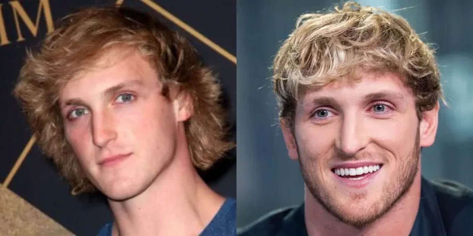 logan paul hairline