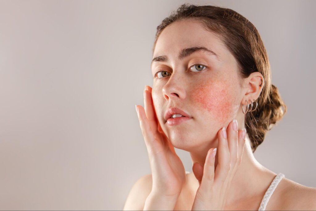 rosacea-nyc-dr-roya