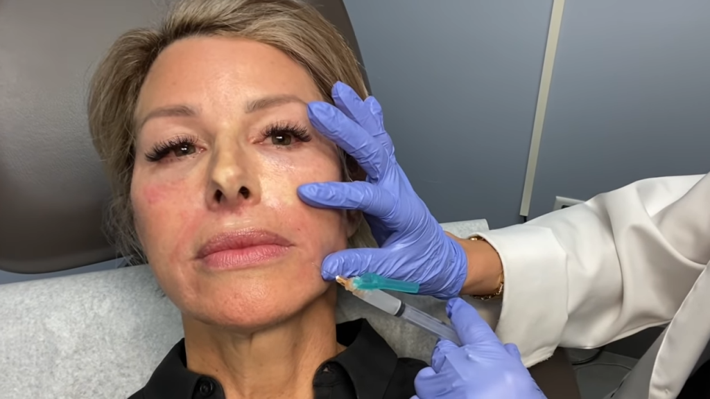 injecting sculptra dermal filler 