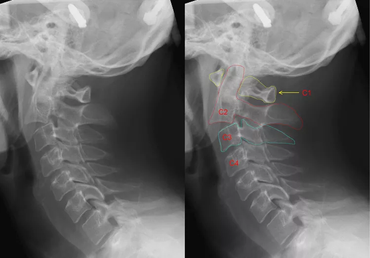 Cervical Fracture - DoveMed