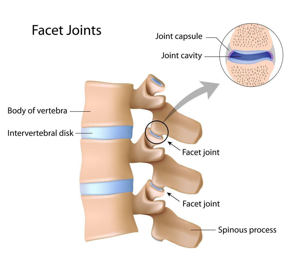 All About Facet Arthropathy: Causes, Symptoms, and Remedies