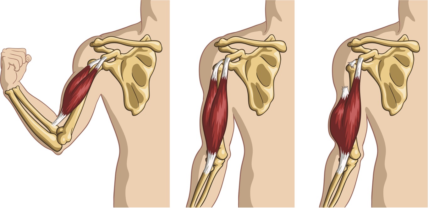 Arm Tendon