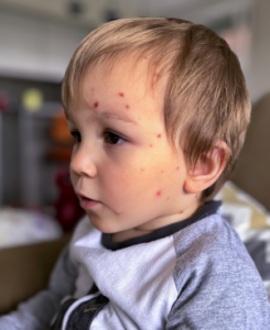 A toddler with chicken pox on his face.