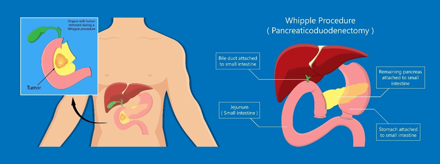 Pancreas Surgery