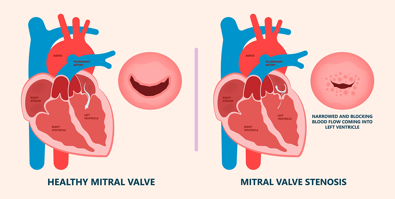 Mitral Valve Lesions Mitral Stenosis And Mitral Regurgitation | Images ...