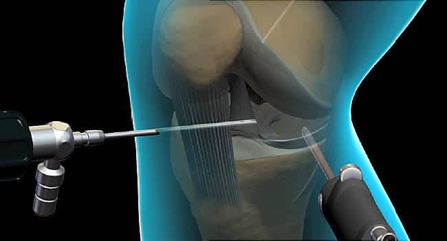 Arthroscopy