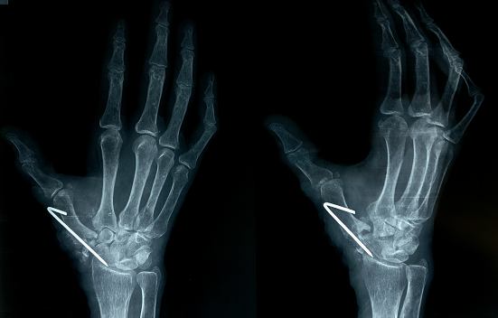 Excision Arthroplasty